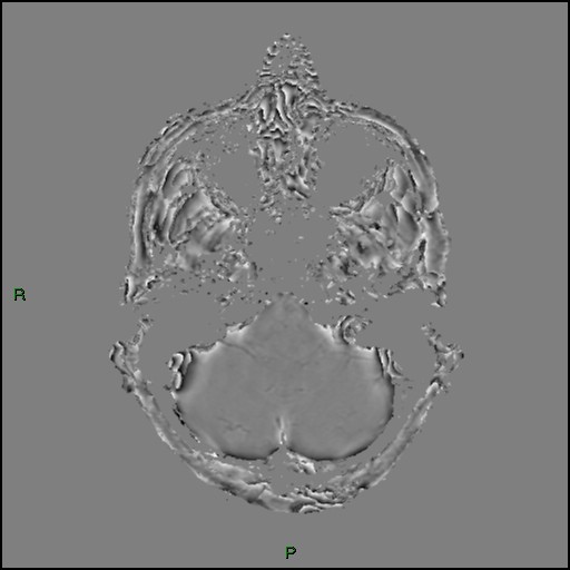 File:Cerebral amyloid angiopathy (Radiopaedia 77506-89664 H 22).jpg