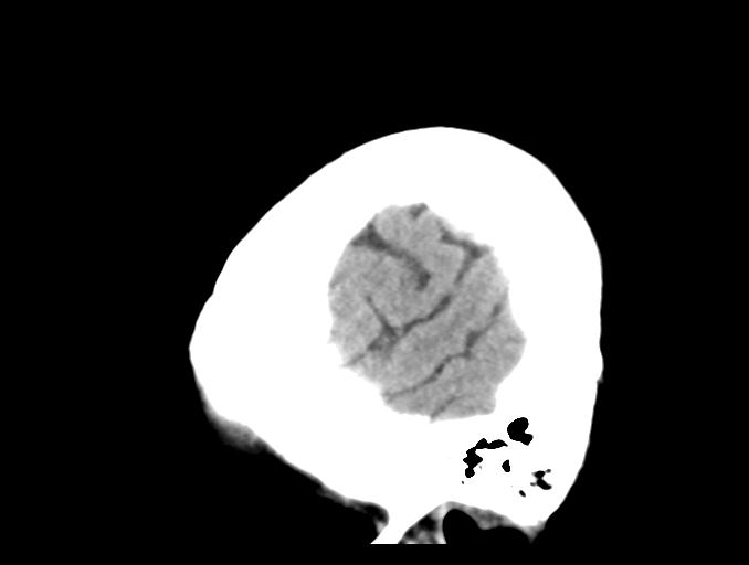 File:Cerebral aneurysm with rupture (Radiopaedia 29933-30457 B 4).jpg