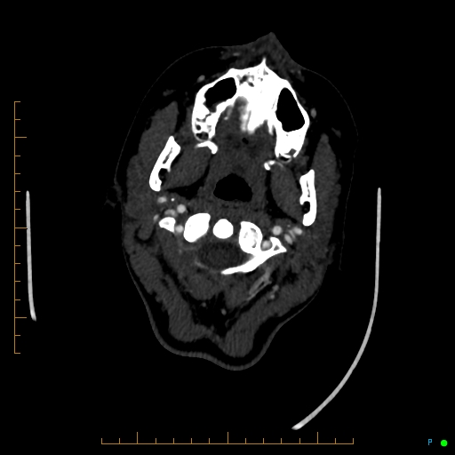 Cerebral arteriovenous malformation (AVM) (Radiopaedia 78162-90706 Axial CTA 25).jpg