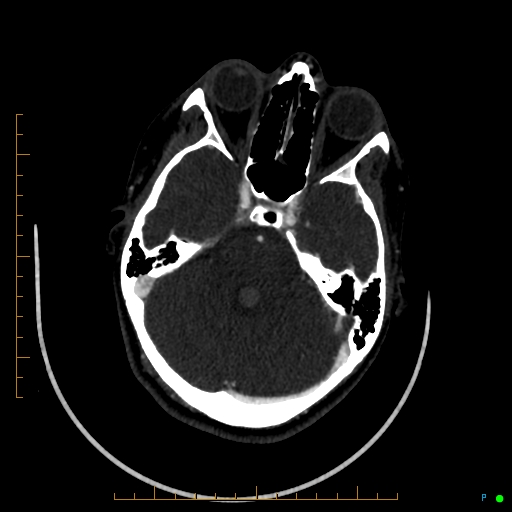 Cerebral arteriovenous malformation (AVM) (Radiopaedia 78162-90706 Axial CTA 94).jpg