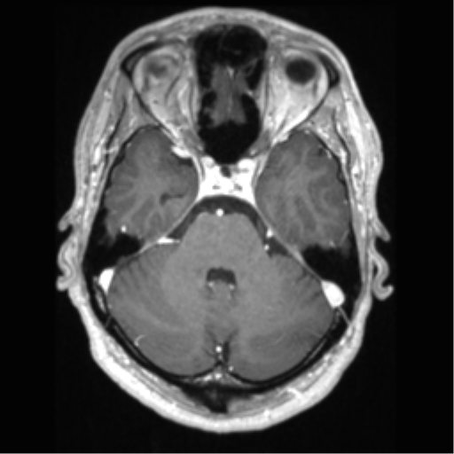 File:Cerebral arteriovenous malformation (Radiopaedia 39259-41506 AX T1 MPR C+ 20).png