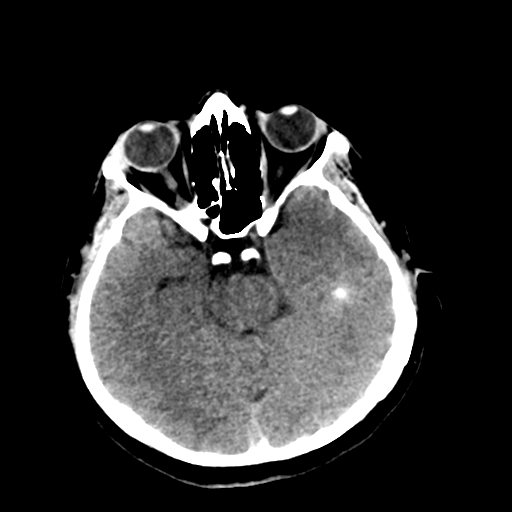 File:Cerebral arteriovenous malformation (Radiopaedia 73830-84645 Axial non-contrast 16).jpg
