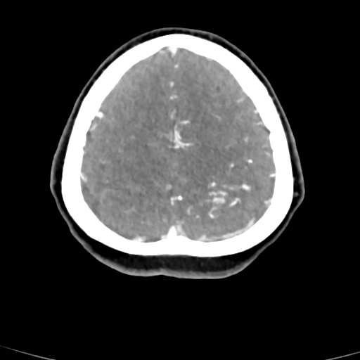 Cerebral arteriovenous malformation (Radiopaedia 73830-84645 B 19).jpg