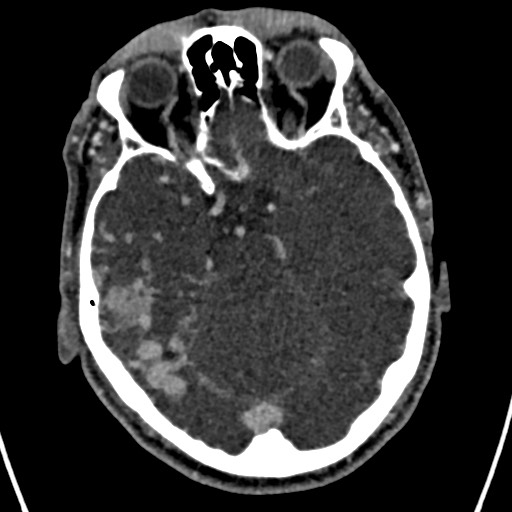 Cerebral arteriovenous malformation (Radiopaedia 78188-90746 Axial C+ delayed 62).jpg
