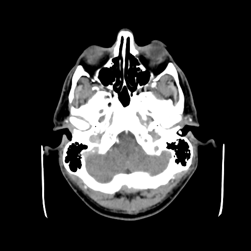 Cerebral arteriovenous malformation (Spetzler-Martin grade 2) (Radiopaedia 41262-44076 Axial C+ 8).png