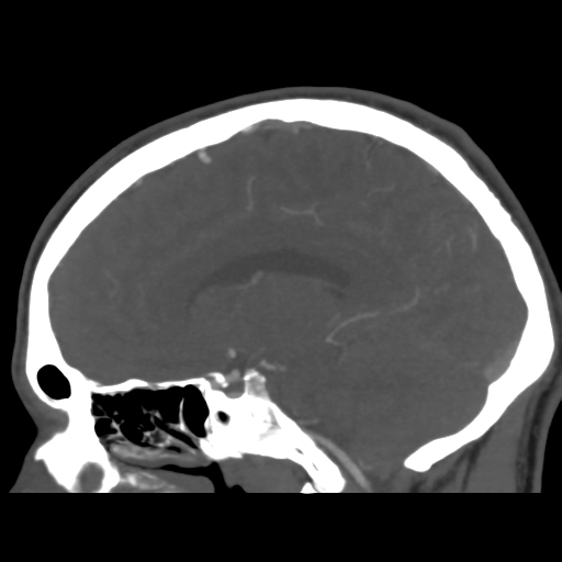 Cerebral arteriovenous malformation (Spetzler-Martin grade 2) (Radiopaedia 41262-44076 G 25).png
