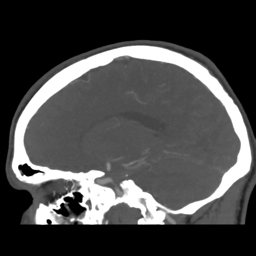Cerebral arteriovenous malformation (Spetzler-Martin grade 2) (Radiopaedia 41262-44076 G 33).png