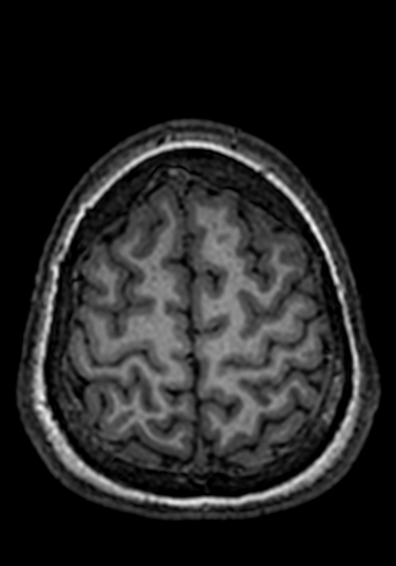 Cerebral arteriovenous malformation at posterior body of corpus callosum (Radiopaedia 74111-84925 Axial T1 35).jpg