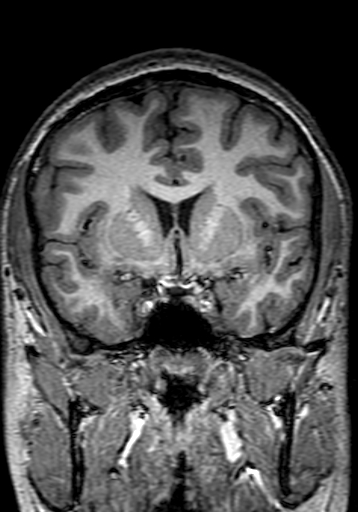 File:Cerebral arteriovenous malformation at posterior body of corpus callosum (Radiopaedia 74111-84925 Coronal T1 121).jpg