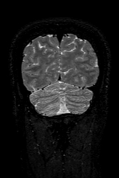 Cerebral arteriovenous malformation at posterior body of corpus callosum (Radiopaedia 74111-84925 Coronal T2 154).jpg