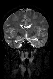 Cerebral arteriovenous malformation at posterior body of corpus callosum (Radiopaedia 74111-84925 Coronal T2 82).jpg
