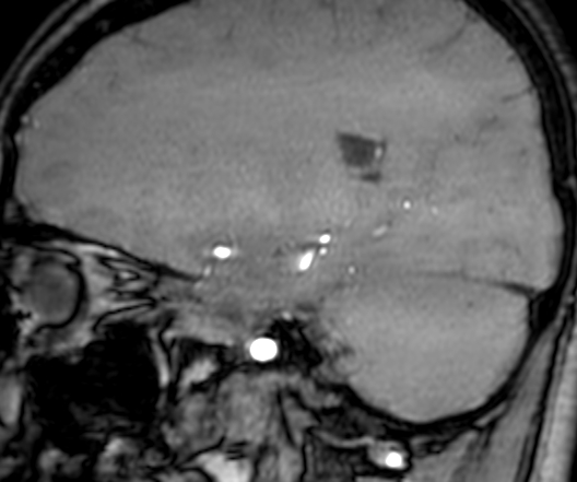 Cerebral arteriovenous malformation at posterior body of corpus callosum (Radiopaedia 74111-84925 J 132).jpg