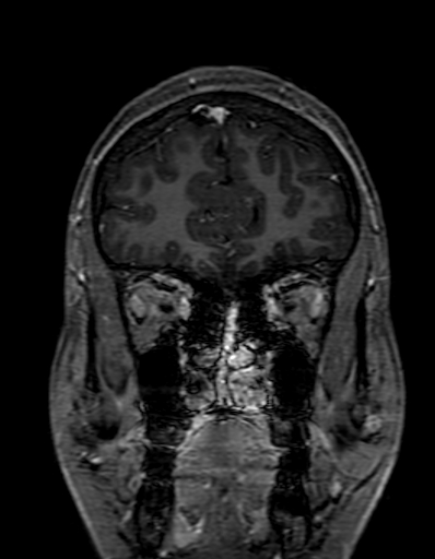 Cerebral arteriovenous malformation at posterior body of corpus callosum (Radiopaedia 74111-84925 K 60).jpg