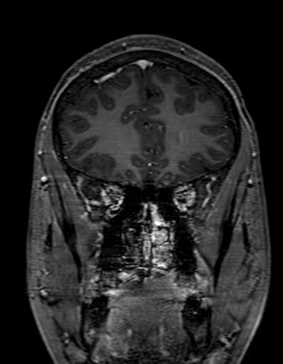 Cerebral arteriovenous malformation at posterior body of corpus callosum (Radiopaedia 74111-84925 K 84).jpg