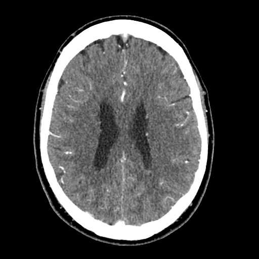 Cerebral arteriovenous malformation with lobar hemorrhage (Radiopaedia 35598-57216 A 40).jpg
