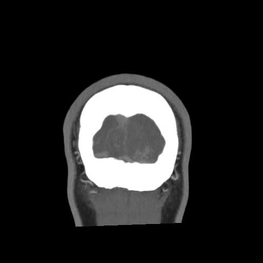 Cerebral arteriovenous malformation with lobar hemorrhage (Radiopaedia 35598-57216 C 90).jpg