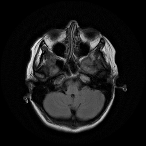 File:Cerebral autosomal dominant arteriopathy with subcortical infarcts and leukoencephalopathy (CADASIL) (Radiopaedia 41018-43768 AX FLAIR (Propeller) 4).png