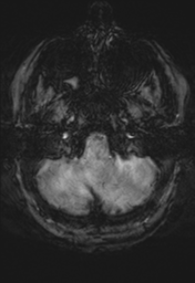 File:Cerebral cavernoma and development venous anomaly (Radiopaedia 37603-39482 Axial SWI 6).png