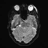 Cerebral cavernous venous malformation (Radiopaedia 70008-80021 Axial DWI 10).jpg