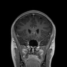 Cerebral cavernous venous malformation (Radiopaedia 70008-80021 Coronal T1 C+ 43).jpg