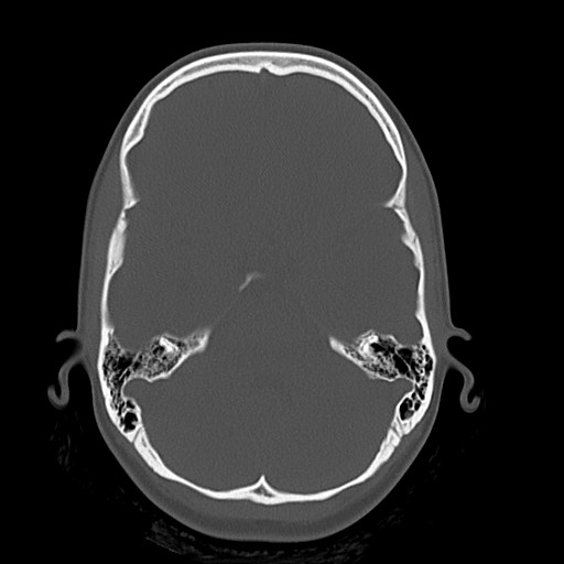 Cerebral cavernous venous malformation (Radiopaedia 70008-80022 Axial bone window 14).jpg