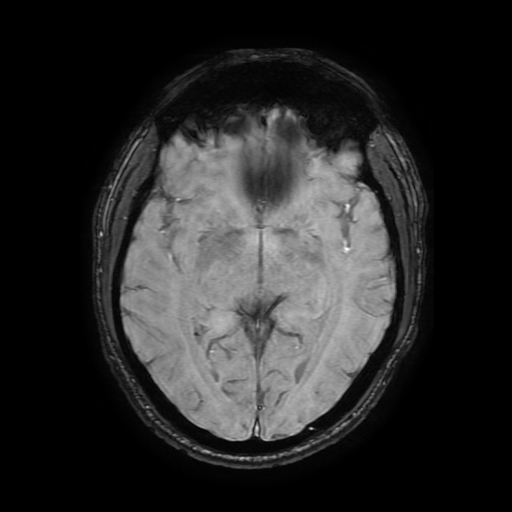 Cerebral cavernous venous malformation (Zabramski type II) (Radiopaedia 85511-101198 Axial SWI 61).jpg