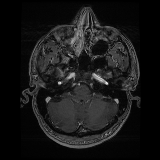 Cerebral cavernous venous malformation (Zabramski type II) (Radiopaedia 85511-101198 Axial T1 C+ fat sat 66).jpg