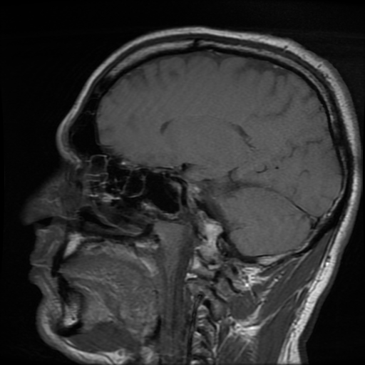 File:Cerebral cavernous venous malformation (Zabramski type II) (Radiopaedia 85511-101198 Sagittal T1 22).jpg