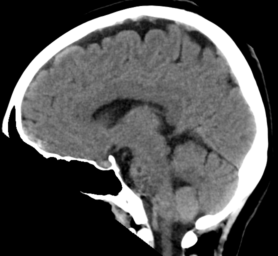 File:Cerebral cavernous venous malformations (Radiopaedia 48117-52945 C 16).png