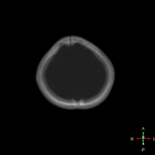 File:Cerebral contusion (Radiopaedia 48869-53911 Axial bone window 3).jpg