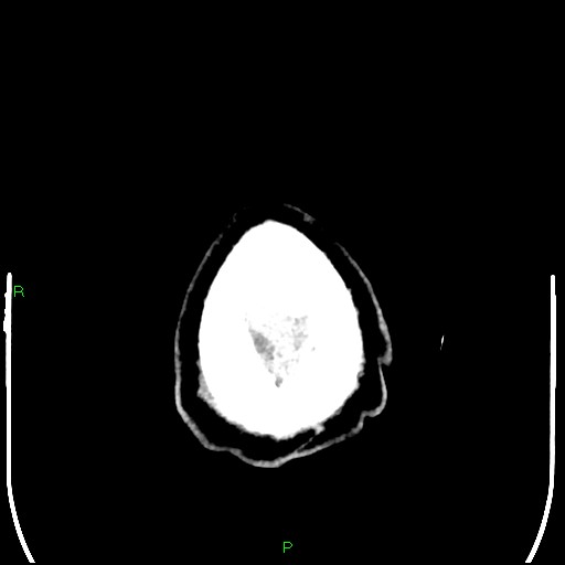 Cerebral contusions (Radiopaedia 33868-35039 Axial non-contrast 215).jpg