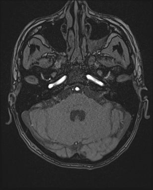File:Cerebral embolic infarcts (embolic shower) (Radiopaedia 72391-82921 Axial MRA 23).jpg