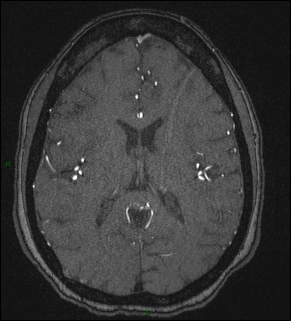 Cerebral fat embolism (Radiopaedia 35022-36525 Axial TOF 122).jpg