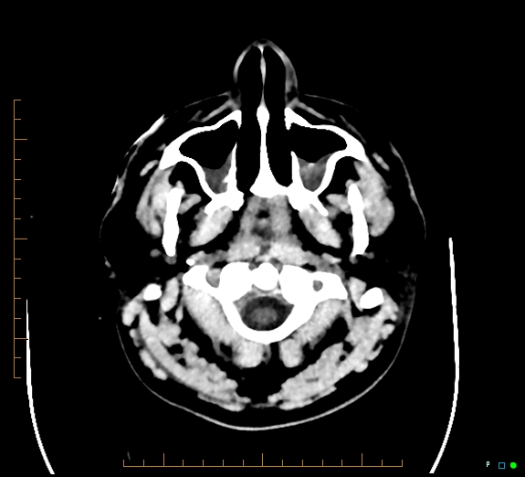 Cerebral fat embolism (Radiopaedia 85521-101220 Axial non-contrast 7).jpg