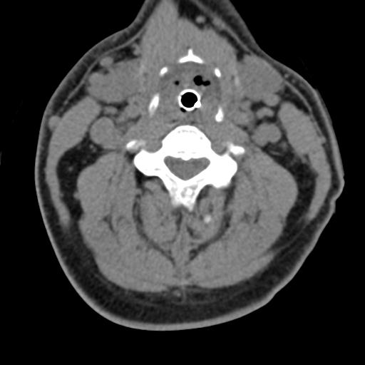 Cerebral hemorrhagic contusions and cervical spine fractures (Radiopaedia 32865-33841 F 26).jpg