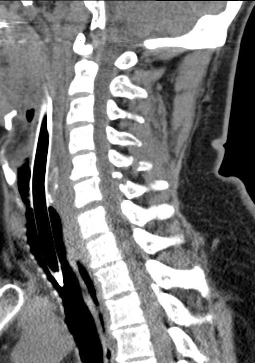 Cerebral hemorrhagic contusions and cervical spine fractures (Radiopaedia 32865-33841 G 55).jpg