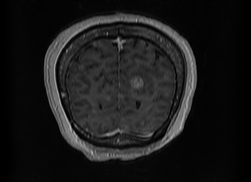 Cerebral metastases from lung cancer with amyloid angiopathy and cerebellopontine angle meningioma (Radiopaedia 74306-85191 Coronal T1 C+ 54).jpg