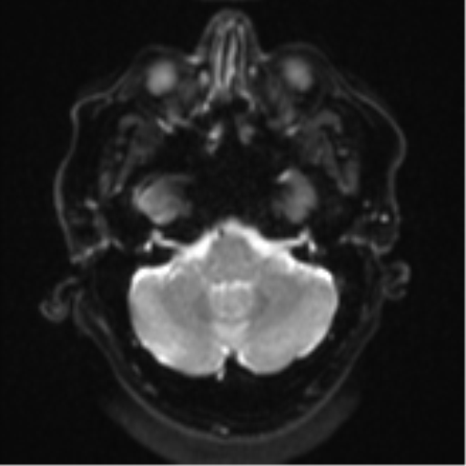 Cerebral metastases mimicking multifocal glioblastoma (Radiopaedia 50843-56353 Axial DWI 6).png