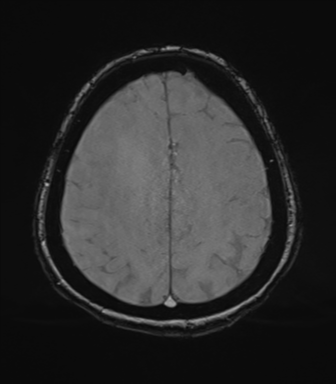 Cerebral metastasis to basal ganglia (Radiopaedia 81568-95413 Axial SWI magnitude 67).png