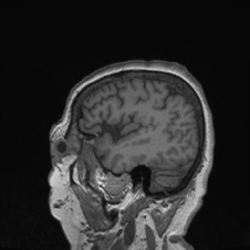 Cerebral metastasis to basal ganglia (Radiopaedia 81568-95413 Sagittal T1 12).png