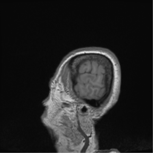 Cerebral metastasis to basal ganglia (Radiopaedia 81568-95413 Sagittal T1 73).png