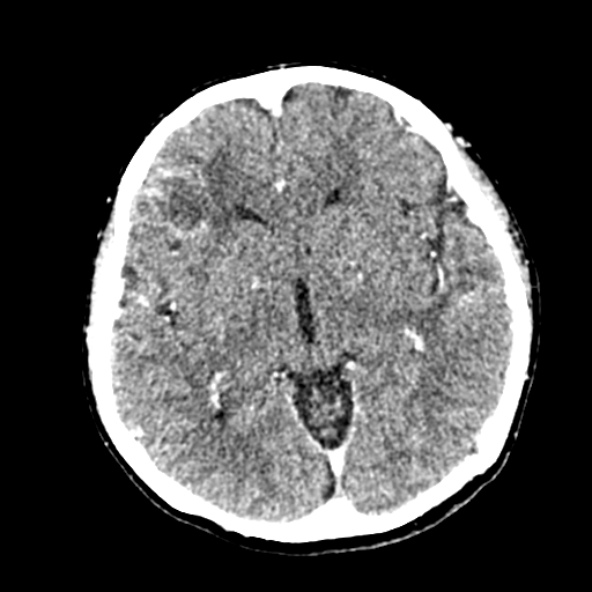 Cerebral ring enhancing lesions - cerebral metastases (Radiopaedia 44922-48818 B 137).jpg