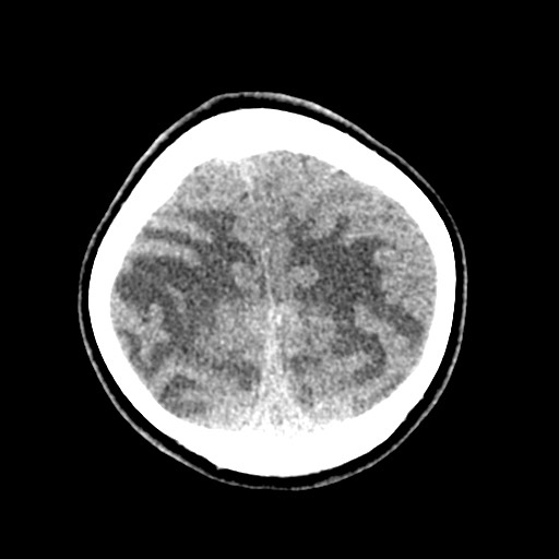 Cerebral tuberculosis with dural sinus invasion (Radiopaedia 60353-68018 Axial non-contrast 52).jpg