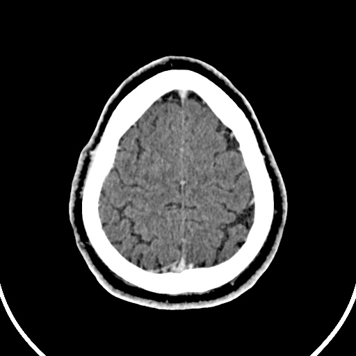 Cerebral venous angioma (Radiopaedia 69959-79977 B 91).jpg