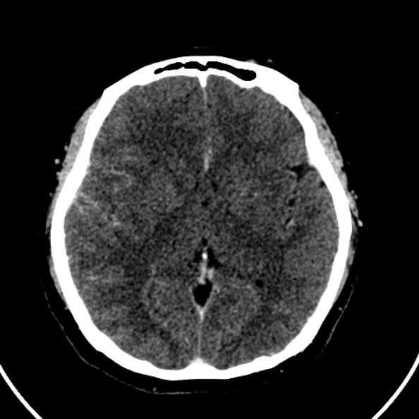 File:Cerebral venous hemorrhagic infarct from venous sinus thrombosis (Radiopaedia 55433-61883 Axial C+ delayed 77).jpg