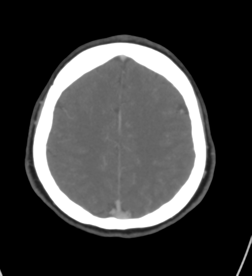 File:Cerebral venous infarction due to transverse sinus thrombosis (Radiopaedia 34688-36120 Axial CT venogram 38).png