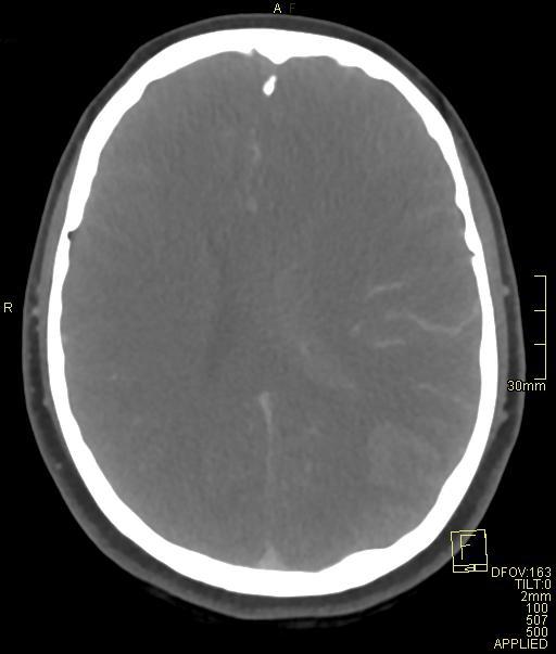 Cerebral venous sinus thrombosis (Radiopaedia 91329-108965 Axial venogram 50).jpg