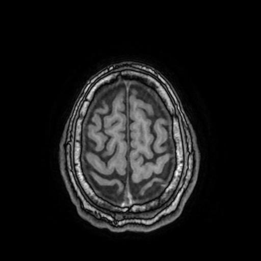 File:Cerebral venous thrombosis with secondary intracranial hypertension (Radiopaedia 89842-106957 Axial T1 145).jpg