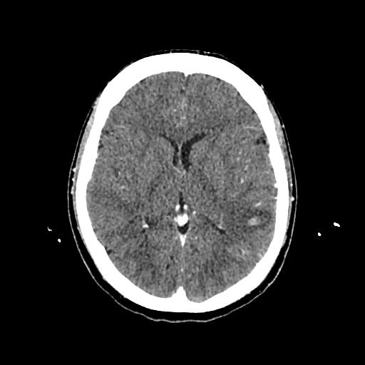 Cerebral venous thrombosis with venous hemorrhagic infarct (Radiopaedia 90354-107660 Axial with contrast 89).jpg