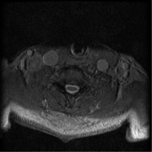 Cervical canal stenosis with cord compression (Radiopaedia 34114-35374 Axial Gradient Echo 26).png
